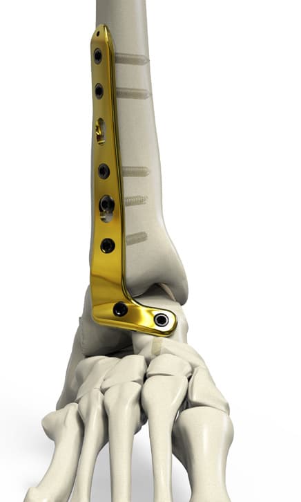 Anterolateral Tibiotalar Fusion Compression Locking Plate(T)
