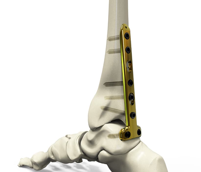 Posterior Tibiotalar Fusion Compression Locking Plate(T)